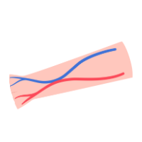 Linfedema